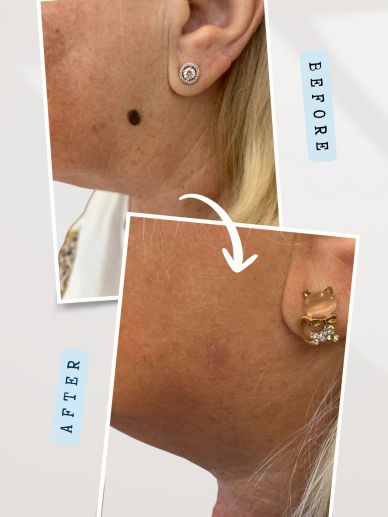 Before and after treatment for waxy brown skin lesion to face - flintshire