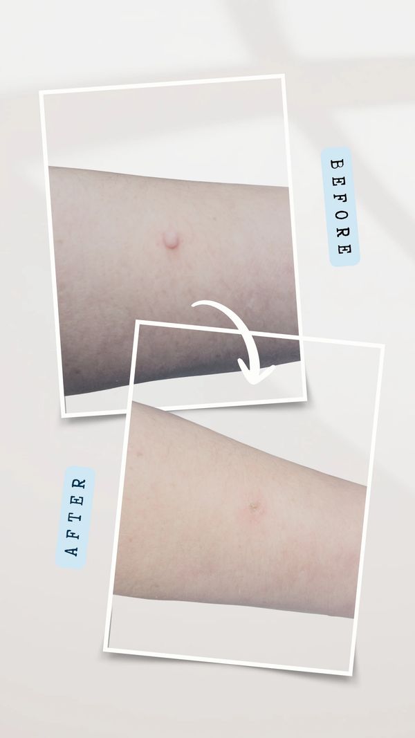 SKIN tag removal from arm hawarden, wirral, Liverpool, chester 