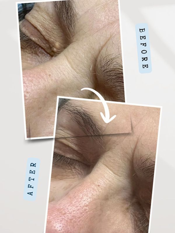 Before and after xanthelasma removal treatment in Hawarden, Flintshire