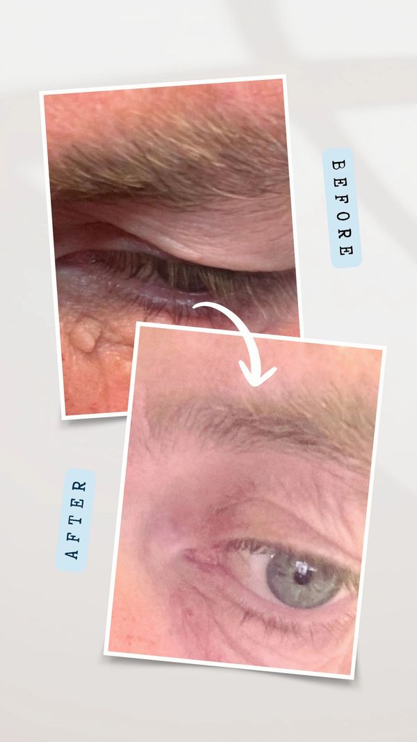 skin tag removal from eye 