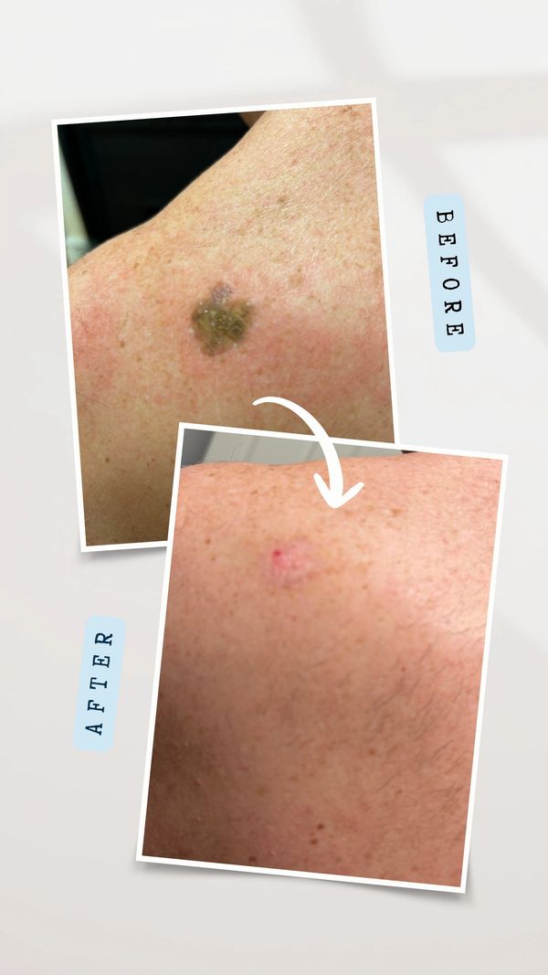 seborrheic keratosis, before and after removal with cryoytherapy 