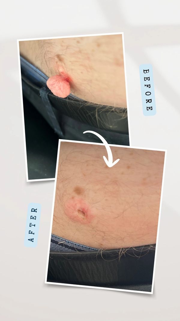 large skin tag removal