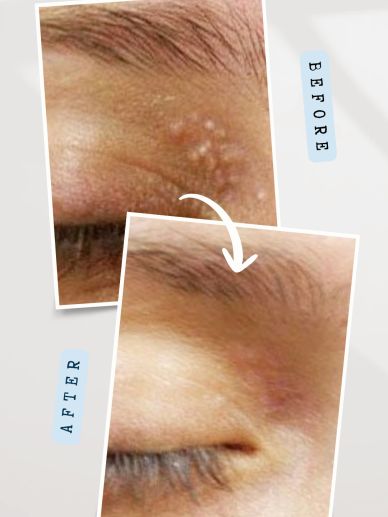 Milia removal results showing smoother skin around the eyelids