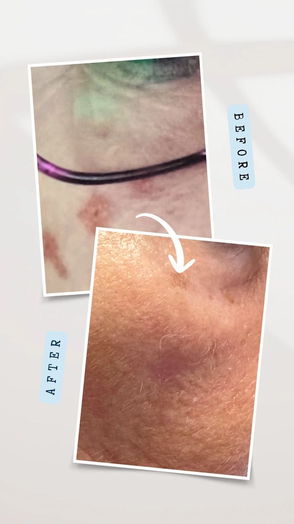 sun pigmentation changes/sun damage removed from face with advanced electrolysis