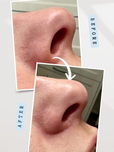 Facial thread vein removal Flintshire - before and after
