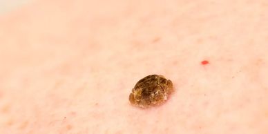 Seborrhoeic keratosis removal results using advanced electrolysis