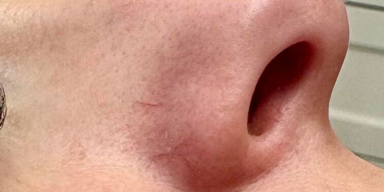Instant facial thread vein removal, hawarden, Deeside, Chester, wirral, before and after