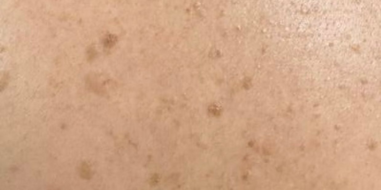 Instant sun damage/hyperpigmentation removal to face hawarden, Deeside, Chester, wirral
