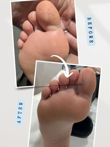 Cryotherapy treatment for plantar verruca in Flintshire