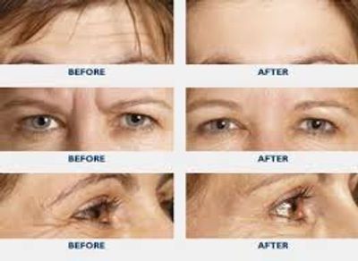 Before and after images showing reduced wrinkles around eyes and forehead.