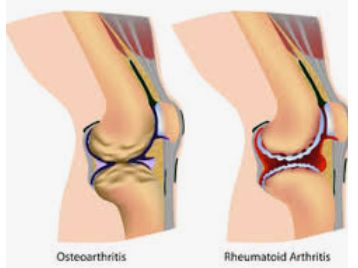 This is you KNEE on Arthritis. Let me help you fix it!