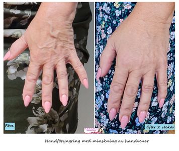 Före och efter bilder som visar handföryngring med minskning av handvener med skleroterapi.