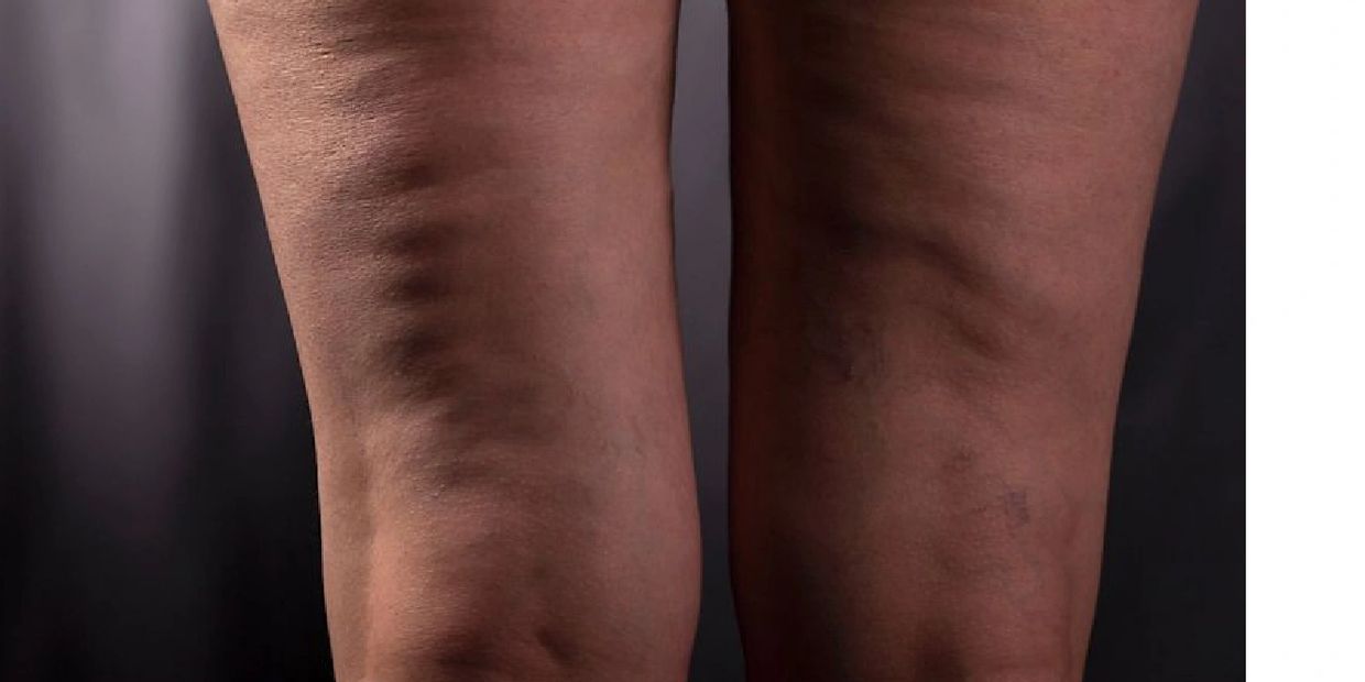 Cellulitbild på baksidan av låret med hudlapphet, utbuktningar och fettlobuler. 