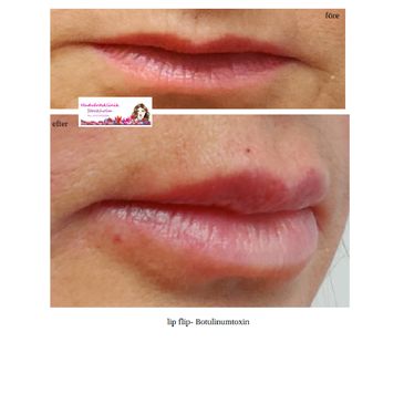 Före och efter bilder för Lip Flip med Botulinumtoxin som visar fylligare läppar o minskade rynkor r