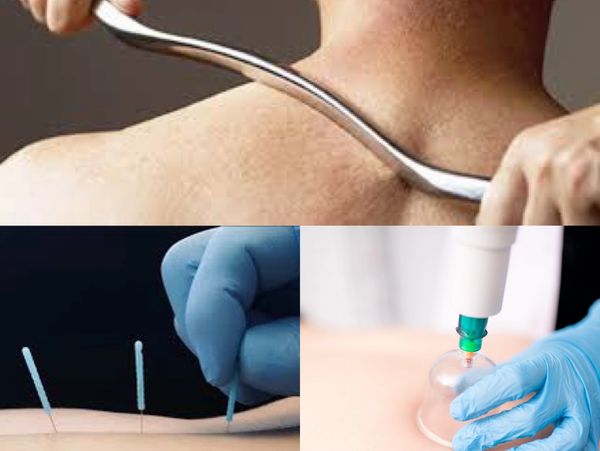 Graston Technique, Dry Needling, Cupping, Physical Therapy, Physical Therapist 