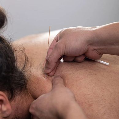 Dry Needling Treatment