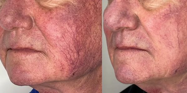 Age/Brown Spot Removal, Intense Pulsed Light - IPL