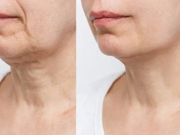 Nefertiti botox neck lift injections neck lines 