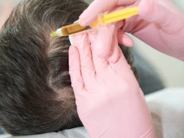 PrP scalp hair loss treatment 