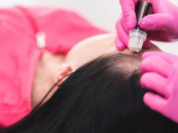 Revitalize hair serum microneedle hair loss treatment 