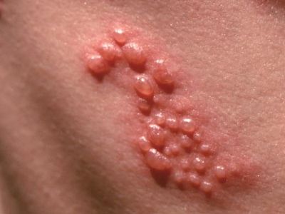 semaglutide and shingles Statins and Shingles