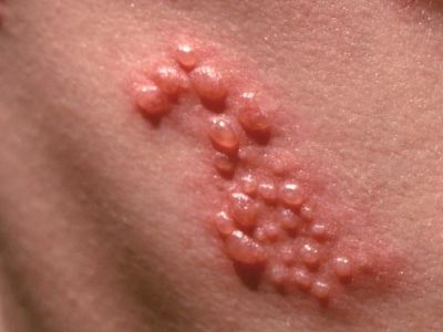 does semaglutide cause shingles | What To Do And How To Treat Statins and Shingles - Is