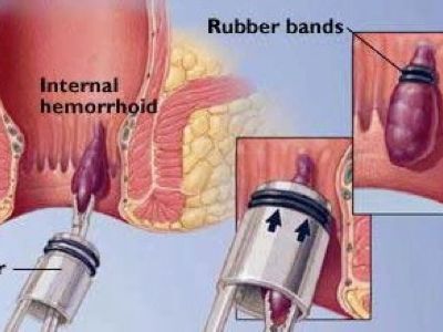 Treating Hemorrhoids