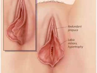 swollen vag lips after c section Case study: Genital swelling following caesarean delivery Bartholin Cyst: What Is It,
