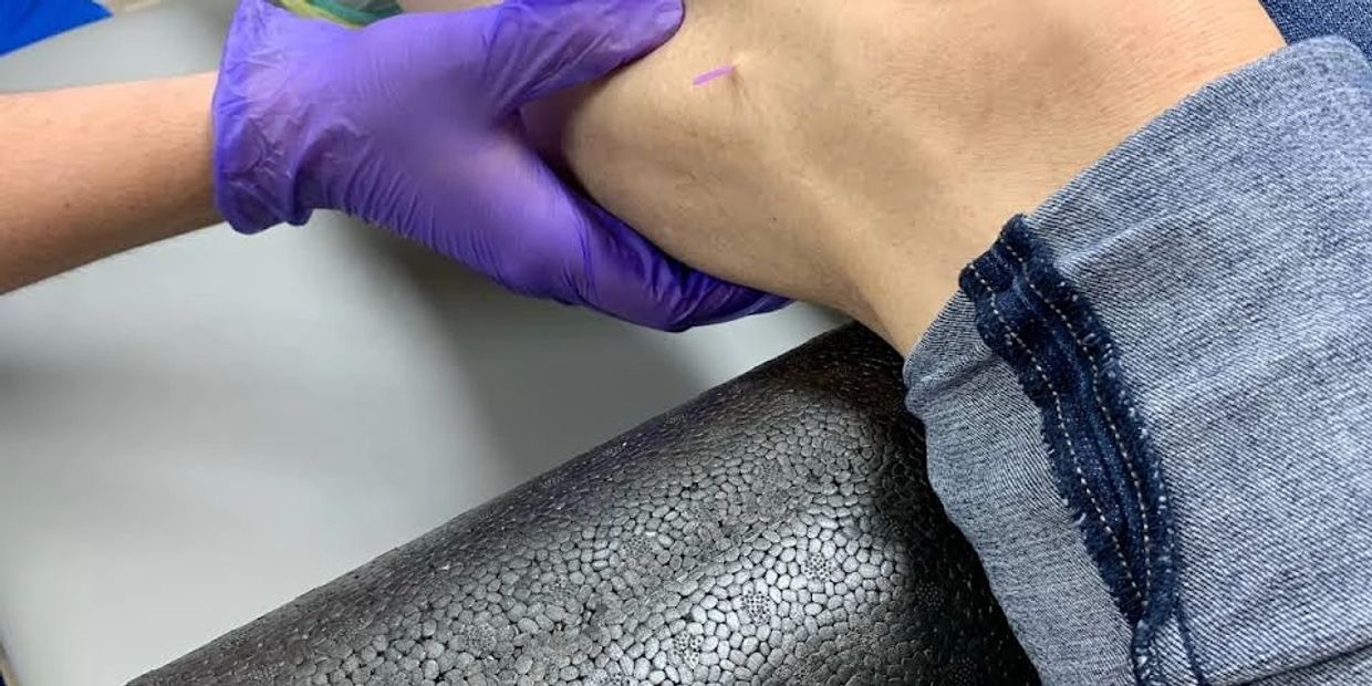 Dry Needling is preformed by our physical therapist that can relieve an array of symptoms and pain.