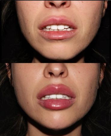 Before and after lip enhancement showing fuller lips.