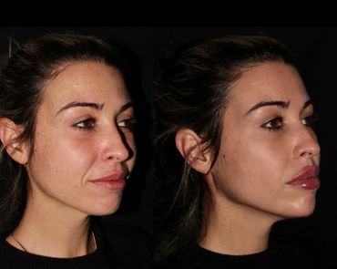 Side-by-side profile of a woman before and after cosmetic enhancement.