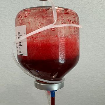 hyperbaric ozone, Zotzmann, IV ozone, high dose ozone, blood ozone treatment