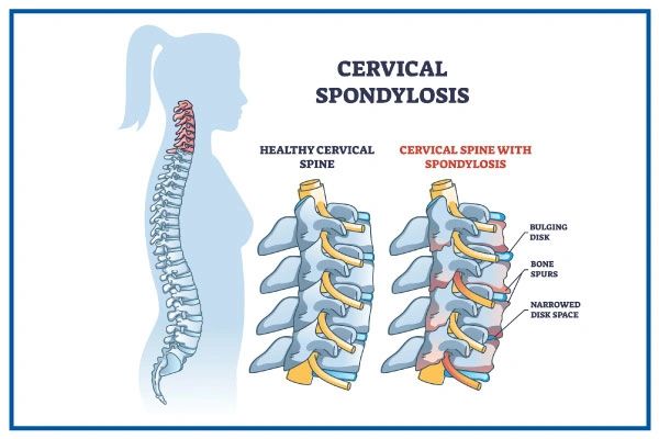 cervical-spondylosis