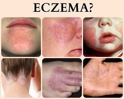 Tips Penjagaan Eczema Dengan Mudah..