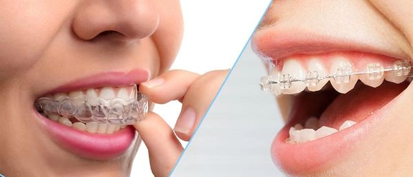 Images of clear aligners or trays and metal braces or brackets. 