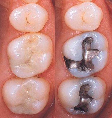 Mercury-free restorations, white fillings, metal-free, composite fillings, before and after