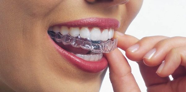 Clear removable aligner or retainer
