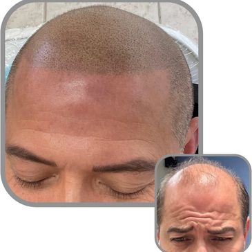 Scalp Micro NJ Arts Scalp Micropigmentation near me before & after receding hairline man