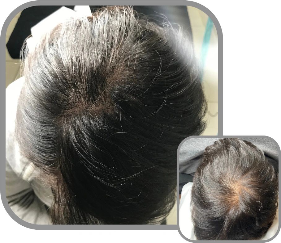 How Scalp Micropigmentation Can Complement Hairstyles for Women
