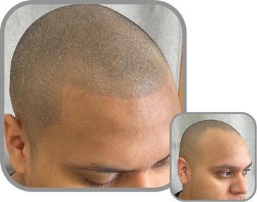 NJ SMP Scalp Micropigmentation near me before & after from Scalp Micro Arts