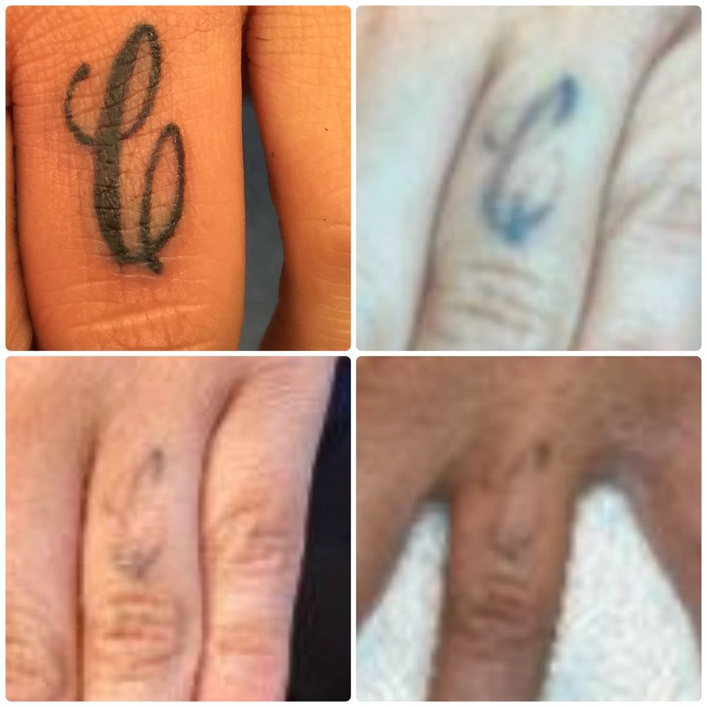 Laser Tattoo Removal progress over 3 treatments