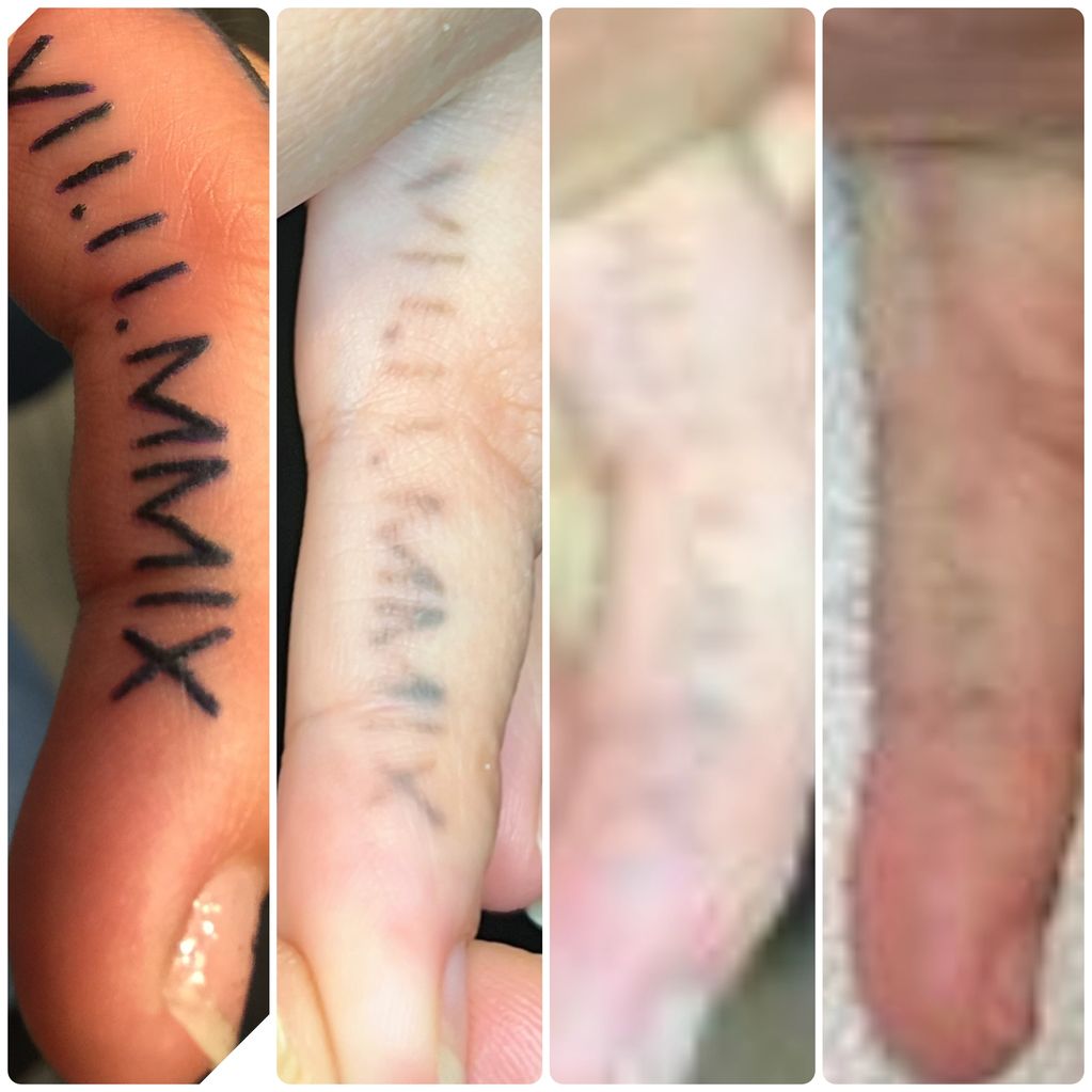 Laser Tattoo Removal progress over 3 treatments
