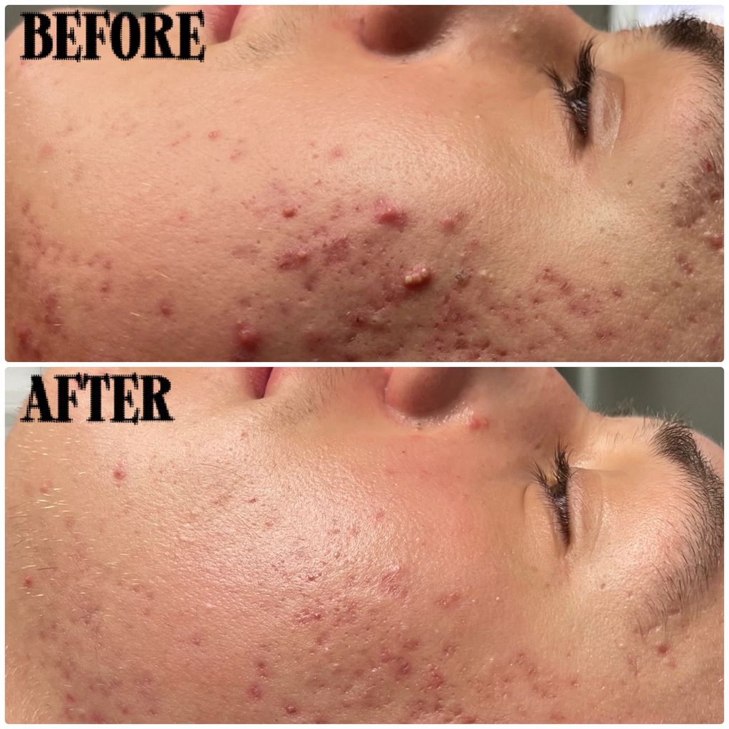 Laser Carbon facial before and after comparison pictures