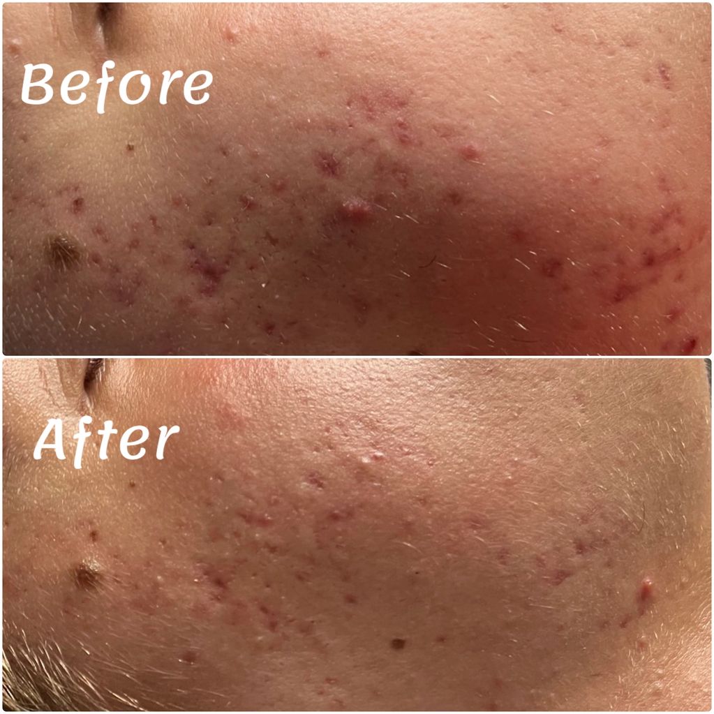 Laser Facial before and after treatment pictures