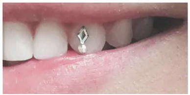 Tooth gem 