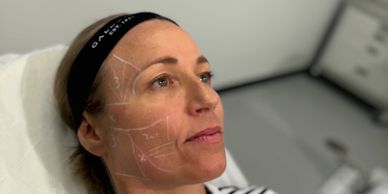Woman with facial contour lines drawn, preparing for a cosmetic procedure.