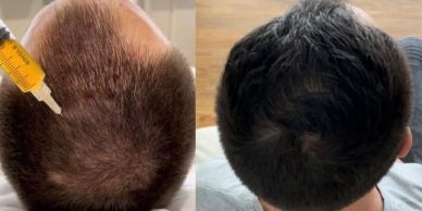 Before and after images showing hair growth treatment results.