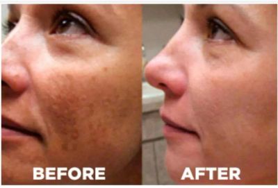 Side-by-side comparison of a woman's face before and after skin treatment.
