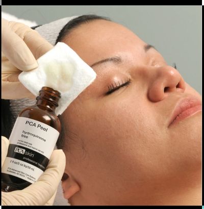 A women receiving a PCA Skin chemical peel