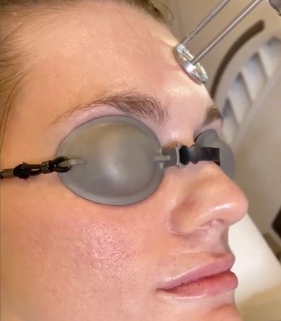 A women getting a Erbium Fractionated Laser Skin Resurfacing